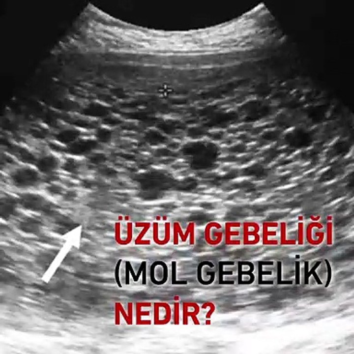 Mol gebelik (üzüm gebeliği) nedir? - www.irfantarhan.com