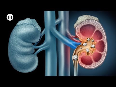 ¿Por qué dan o qué genera las piedras en los riñones?