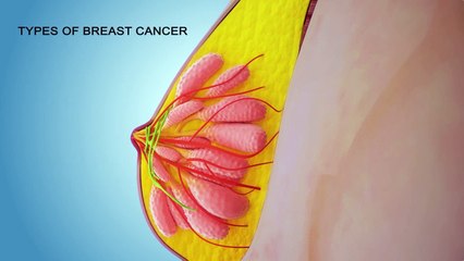 Breast Cancer – A 3D Medical Animation by ADI Intellect