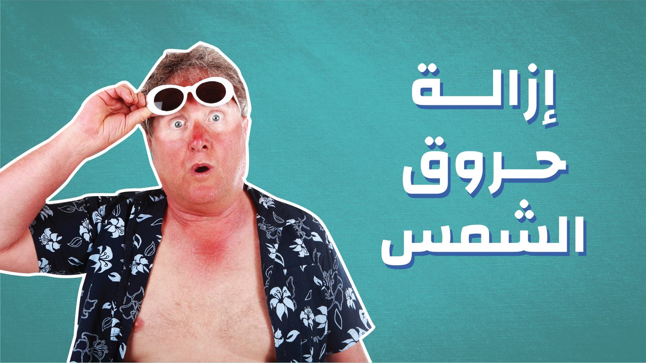 إزالة حروق الشمس