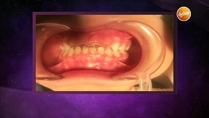 كوارث أكل السكريات قبل النوم وخطورتها على الأسنان| هي وبس