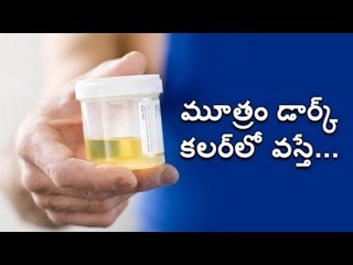 Dark urine: Causes, Symptoms