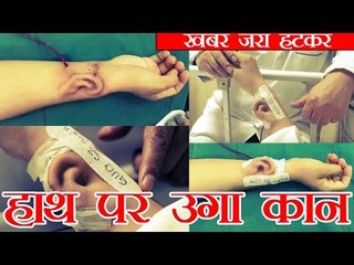 जब एक आदमी के हाथ पर उग आया कान | Chinese man grows new ear on arm for transplant