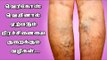 Varicose veins cause & How to prevent varicose veins ! |
