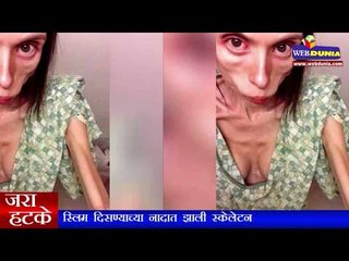 स्लिम दिसण्याच्या नादात झाली स्केलेटन