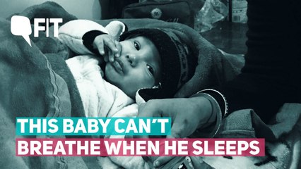 This Baby Can't Breathe When He Sleeps