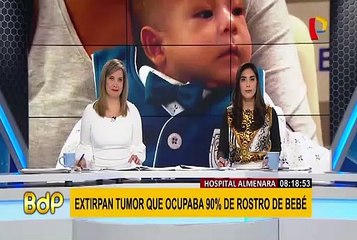 Hospital Almenara: extirpan tumor que ocupaba 90% del rostro de un bebé