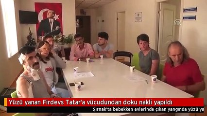 Yüzü yanan Firdevs Tatar'a vücudundan doku nakli yapıldı