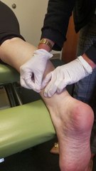 Dry Needling