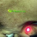Laser skin rejuvenation using long pulse & ultra short pulse technologies