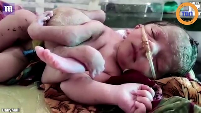 Inde : un bébé naît avec trois bras et quatre jambes !