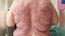 Cold weather causes woman to break out in spidery purple rash