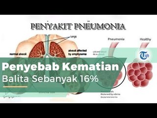 Pneumonia, atau Lebih Dikenal dengan Paru-paru Basah