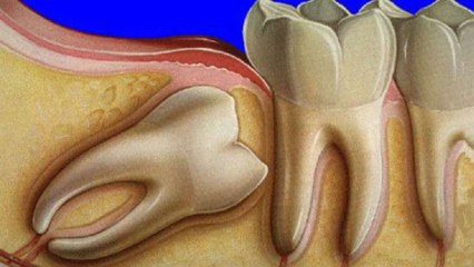 ماذا تعرف عن الأسنان المدفونة.. وما أسباب ظهورها؟