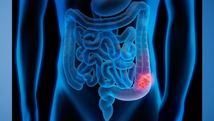 bd-diferencia-entre-colon-irritable-y-colitis-300919