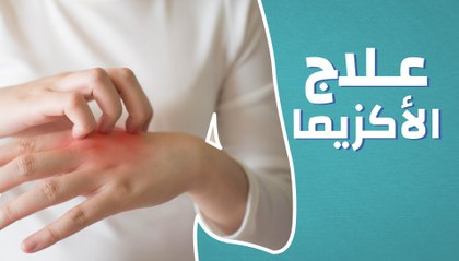 علاج الاكزيما