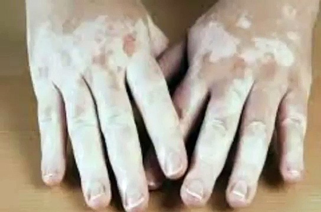 علاج البهاق من منتجات شركة Dxn الماليزية العالمية