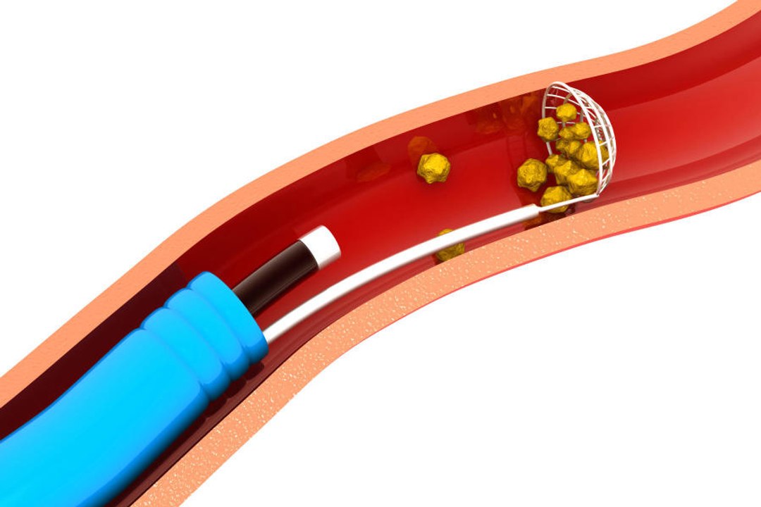 Ureteroskopie, eine Technik zur Entfernung von Nierensteinen