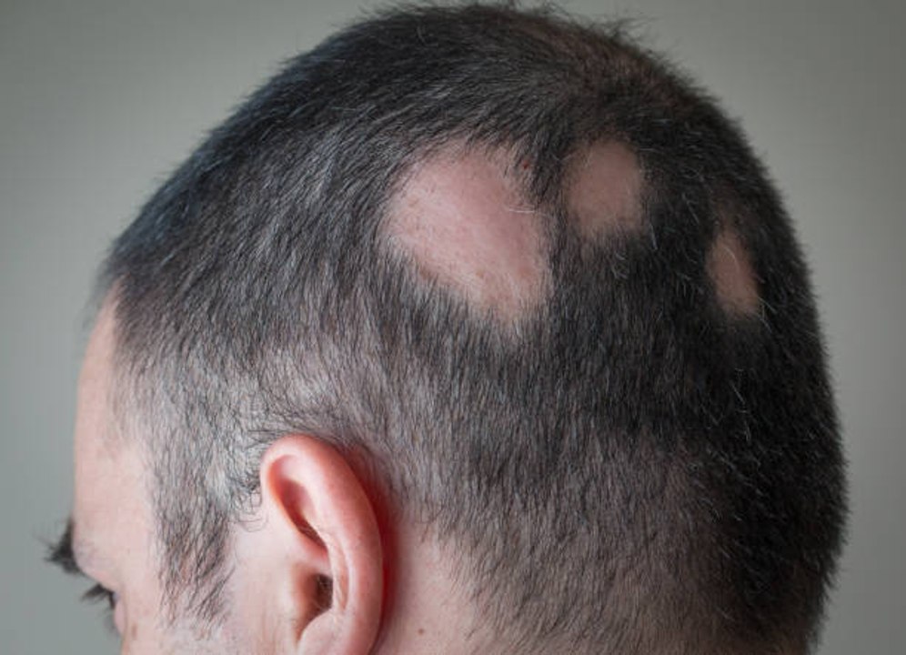 Was ist Alopecia?