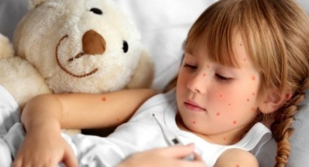 Sağlık Bakanlığı: Son iki yılda 9 olan kızamık vakası 716'ya yükseldi