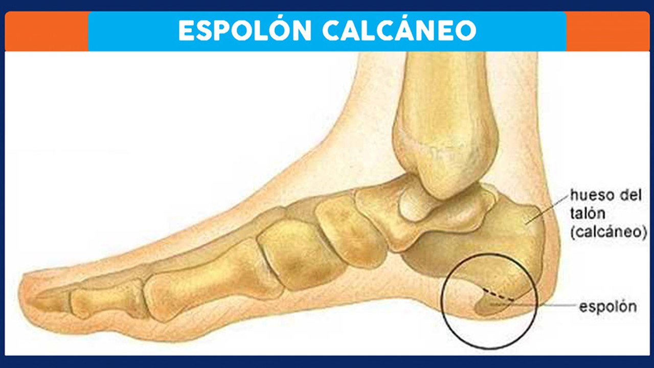 bd-causas-y-tratamientos-de-espolon-041019