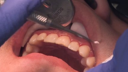 bd-daños-dentales-por-diabetes-hipertension-y-tiroides-081019