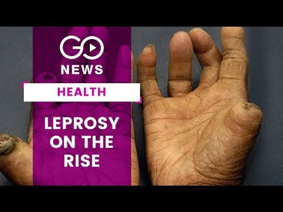 Leprosy On The Rise