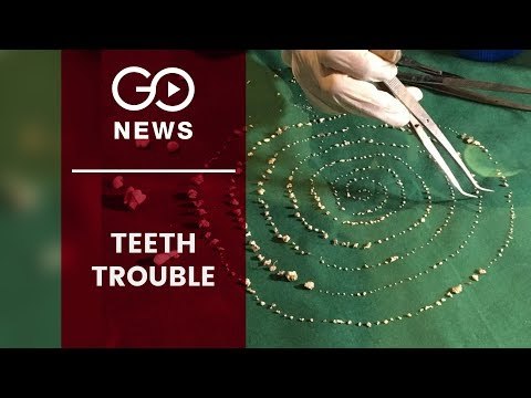 526 Teeth Removed From Boy's Mouth