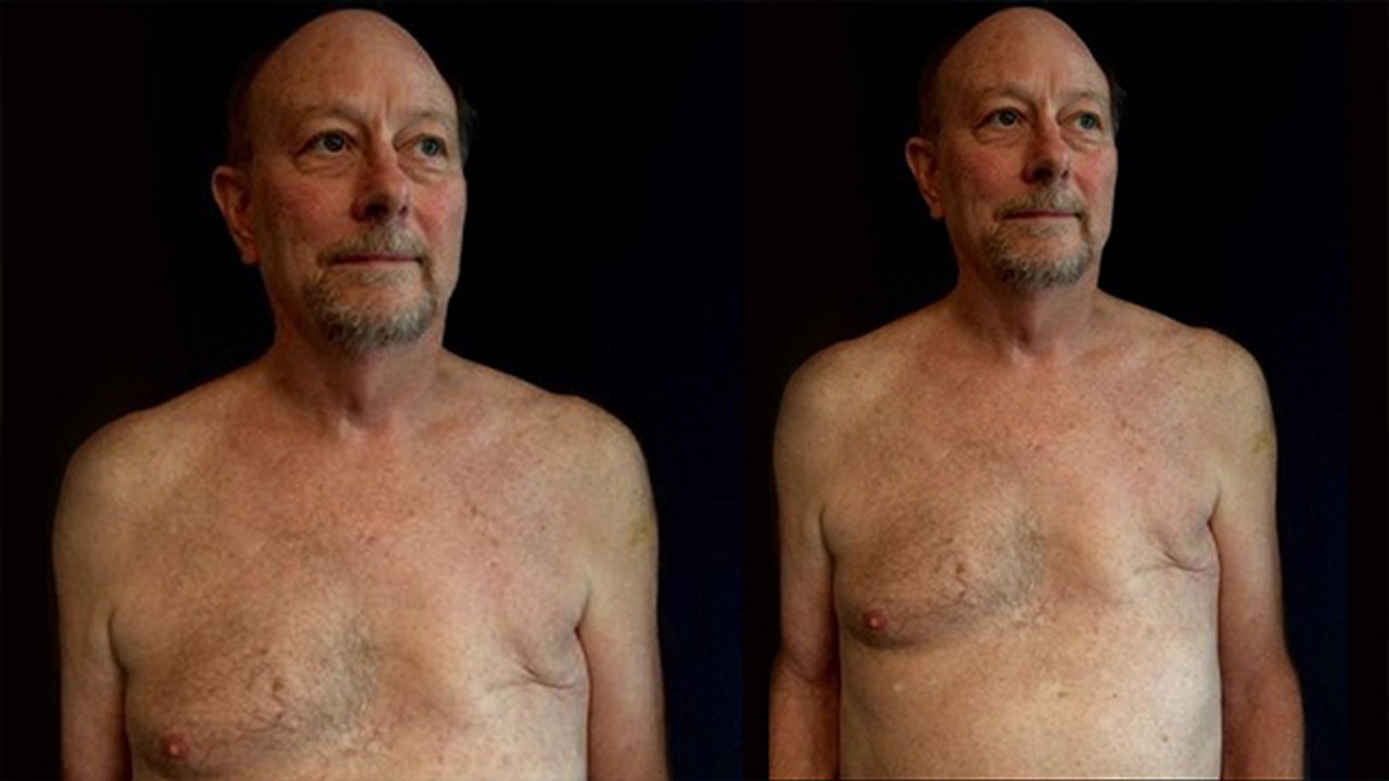 Self Breast Exams for Men : Signs & Symptoms | पुरूषों को भी होता है स्तन कैंसर, ये है लक्षण Boldsky