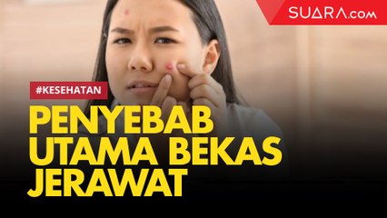 Pakar Kulit Ungkap Penyebab Utama Luka Bekas Jerawat pada Wajah