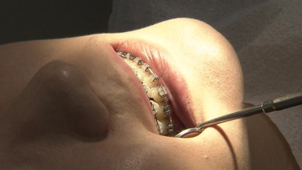 수술 vs 비수술...나에게 맞는 부정교합 치료법은? / YTN