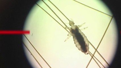 Santé - A bout des poux !