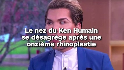 Le nez du Ken Humain  se désagrège après une  onzième rhinoplastie