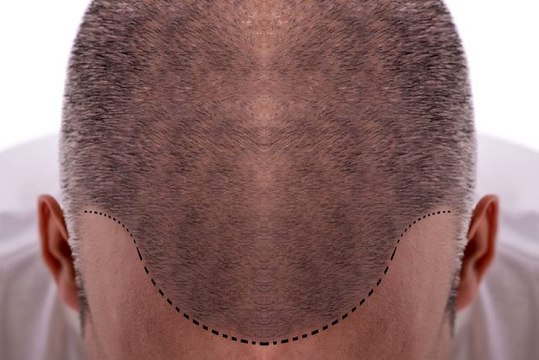 Saç ekimi nedir, saç ekimi nasıl yapılır? Saç ekimi fiyatları ve saç ekimi sonuçları