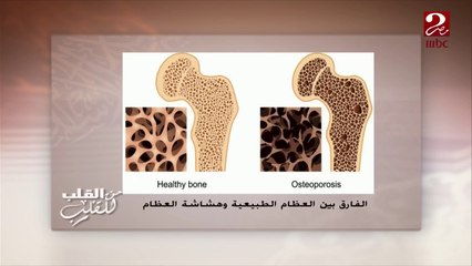 #من_القلب_للقلب | بالصور... تعرف على شكل هشاشة العظام والأماكن الأكثر عُرضة للكسر