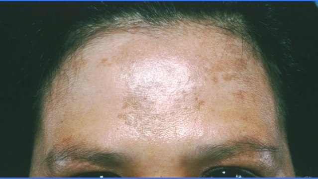 bd-melasma-causas-tratamientos-101019