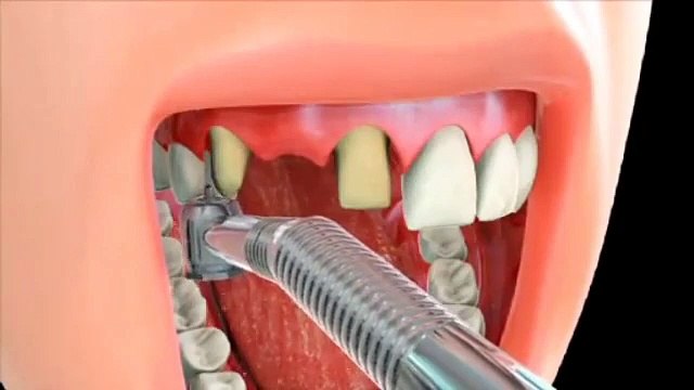 Dental Bridges Treatment