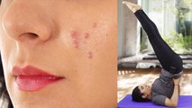 Pimples को दूर करेगा ये योगासन | Yoga for Pimples | Boldsky