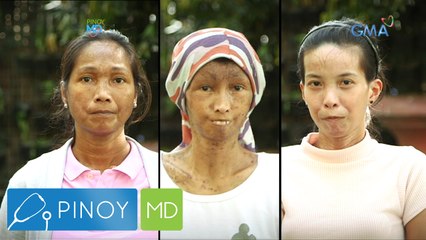 Pinoy MD: Tatlong babae, pinahihirapan ng sakit na Scleroderma