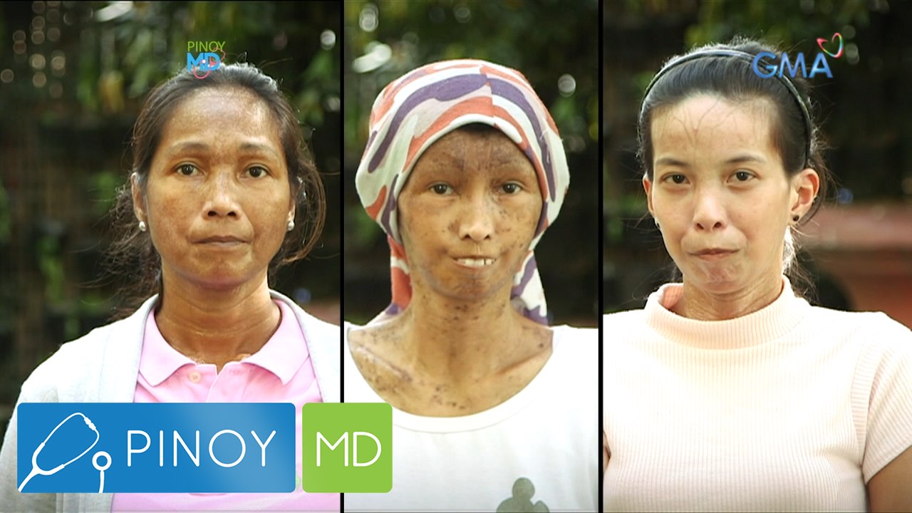 Pinoy MD: Tatlong babae, pinahihirapan ng sakit na Scleroderma
