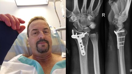 El youtuber demuestra en carne propia que los deportes de riesgo merecen su nombre