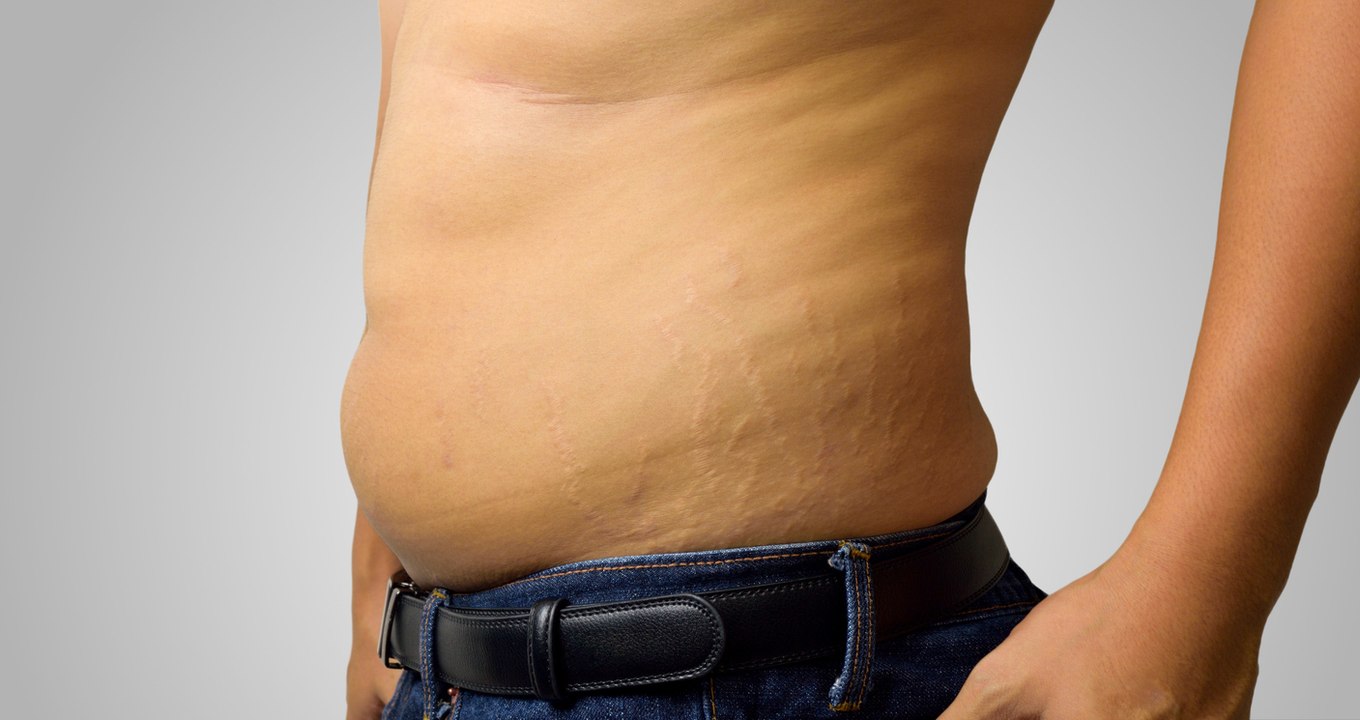 ¿Los hombres sufren de celulitis?
