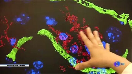Investigadores españoles demuestran que un anticoagulante oral retrasa la aparición del alzhéimer