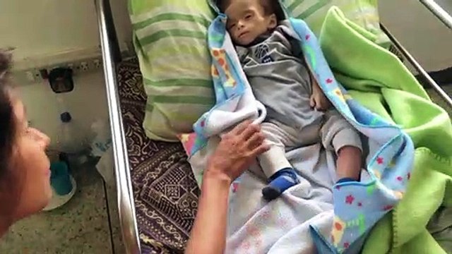 Uno de cada tres niños pequeños sufre desnutrición o sobrepeso en el mundo