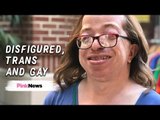 Surviving gender dysphoria as a disfigured, transgender, gay woman