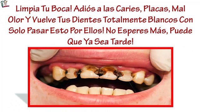 ¡Inventan en España un método para decirle adiós a las caries para siempre!