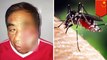 Garuk bekas gigitan nyamuk, pria terkena infeksi mematikan - TomoNews