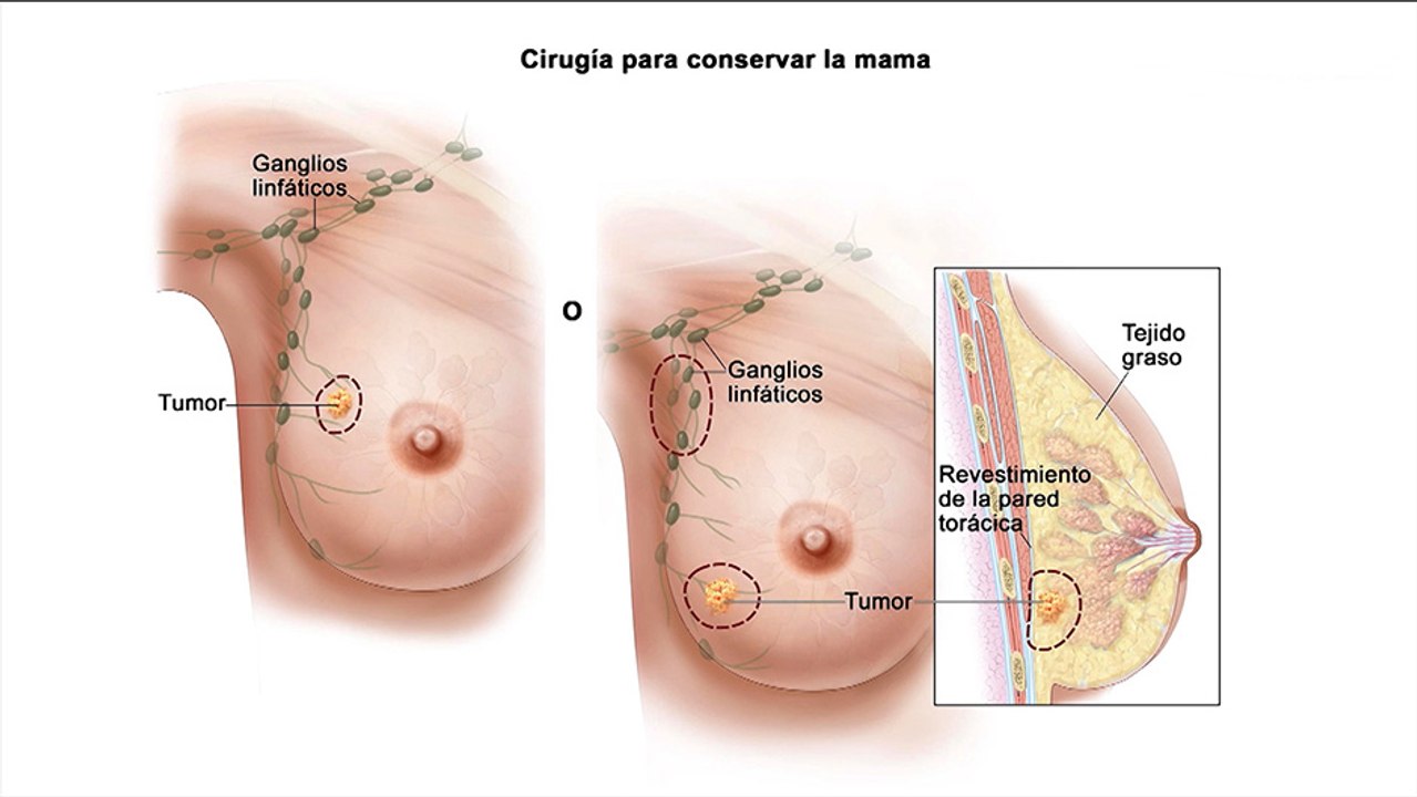 bd-técnicas-quirurgicas-cáncer-de-mama-231019
