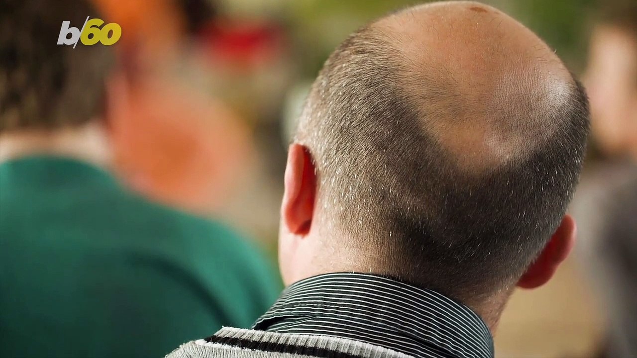 Working Overtime Could Be Making You Go Bald