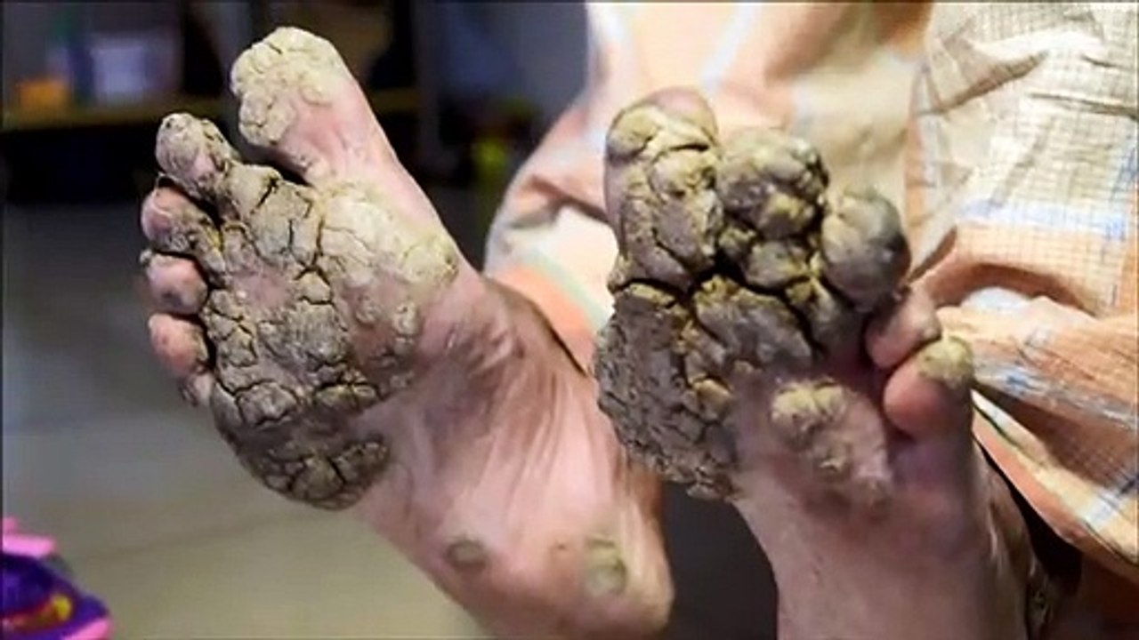 Doenças raras afetam 300 milhões no mundo